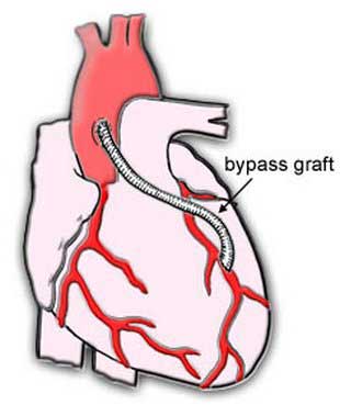 bypass-surgery