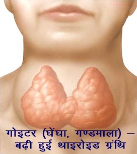 Goiter - Enlarged Thyroid Gland